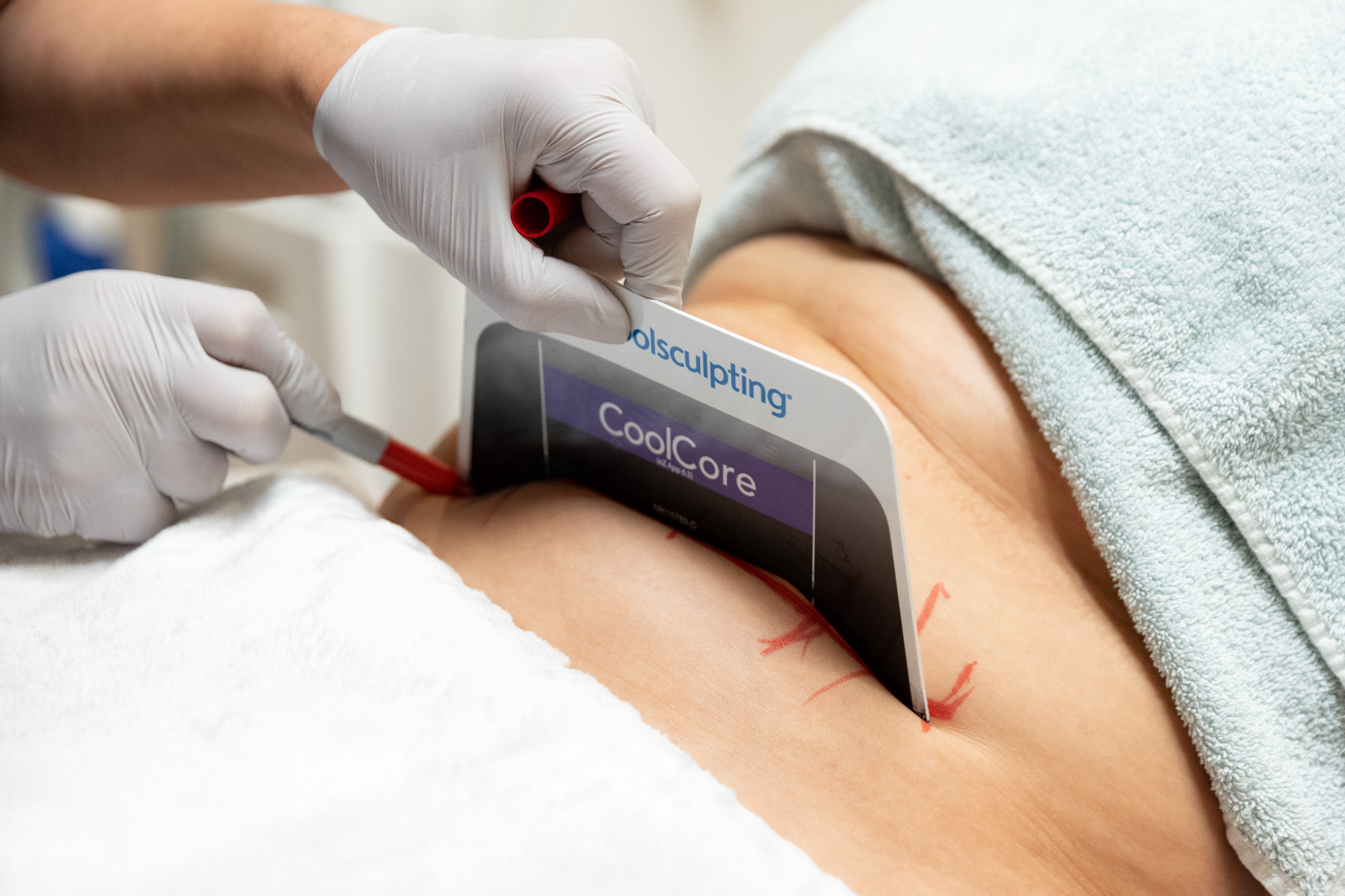 Spring into Shape with CoolSculpting at Wisconsin Vein Center & MediSpa Image