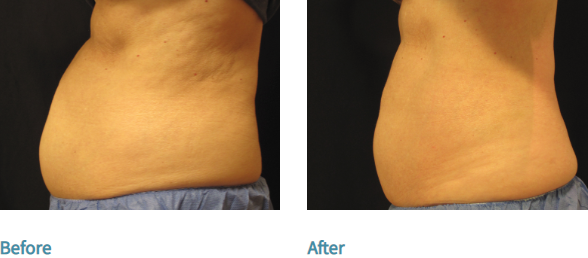 Why Choose CoolSculpting Over Liposuction? Image