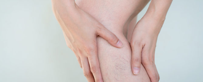 Do Leg Veins Go Away on Their Own? Image