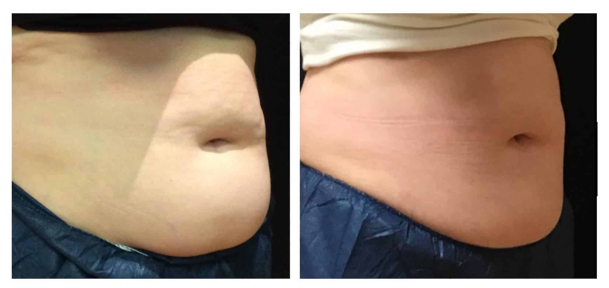 SculpSure vs CoolSculpting  Colen, Larry ()