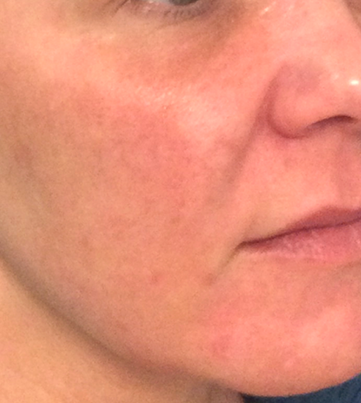 LaseMD Case #195 Before Image