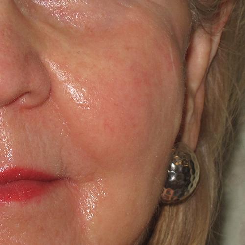 Facial Vein Treatment Case #74 After Image