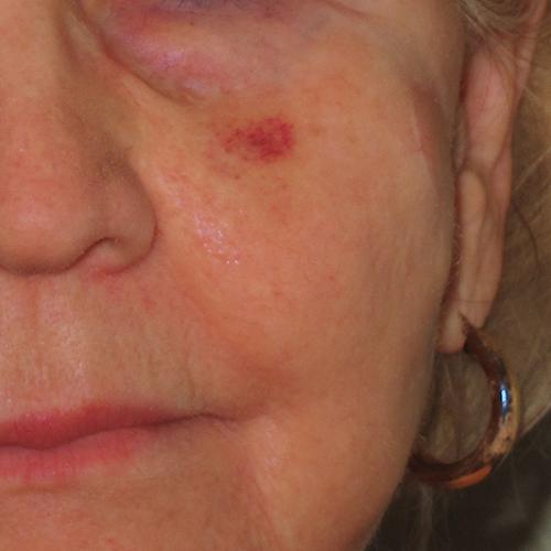 Facial Vein Treatment Case #74 Before Image