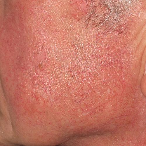 Facial Vein Treatment Case #75 After Image
