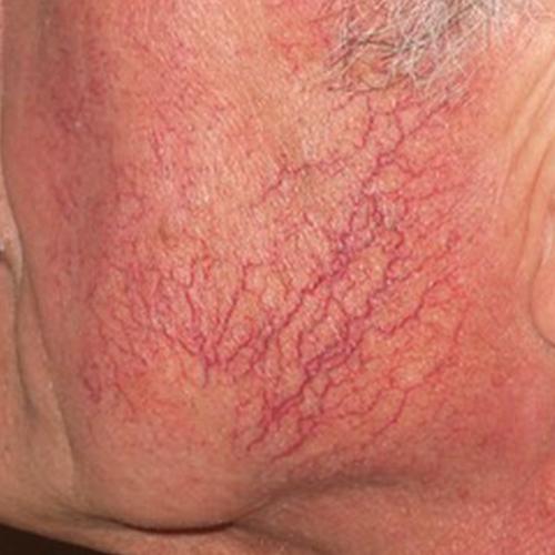 Facial Vein Treatment Case #75 Before Image