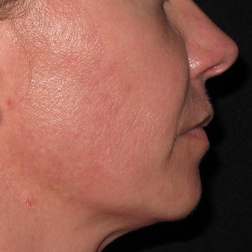 RF Microneedling Case #78 After Image