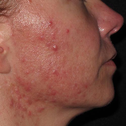 RF Microneedling Case #78 Before Image