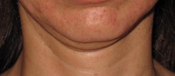 RF Microneedling Case #92 Before Image
