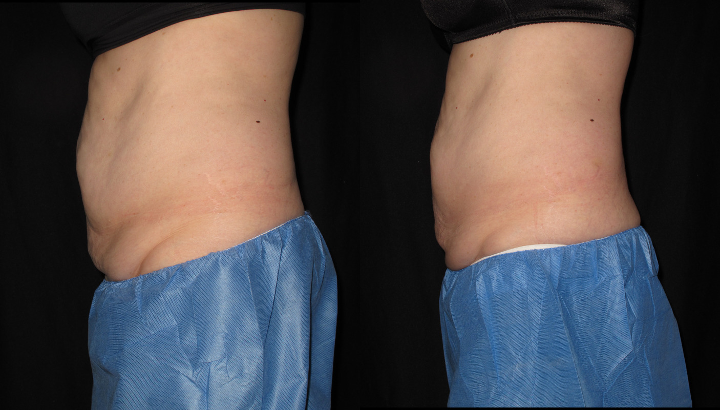 Coolsculpting Case #169 Marge Image