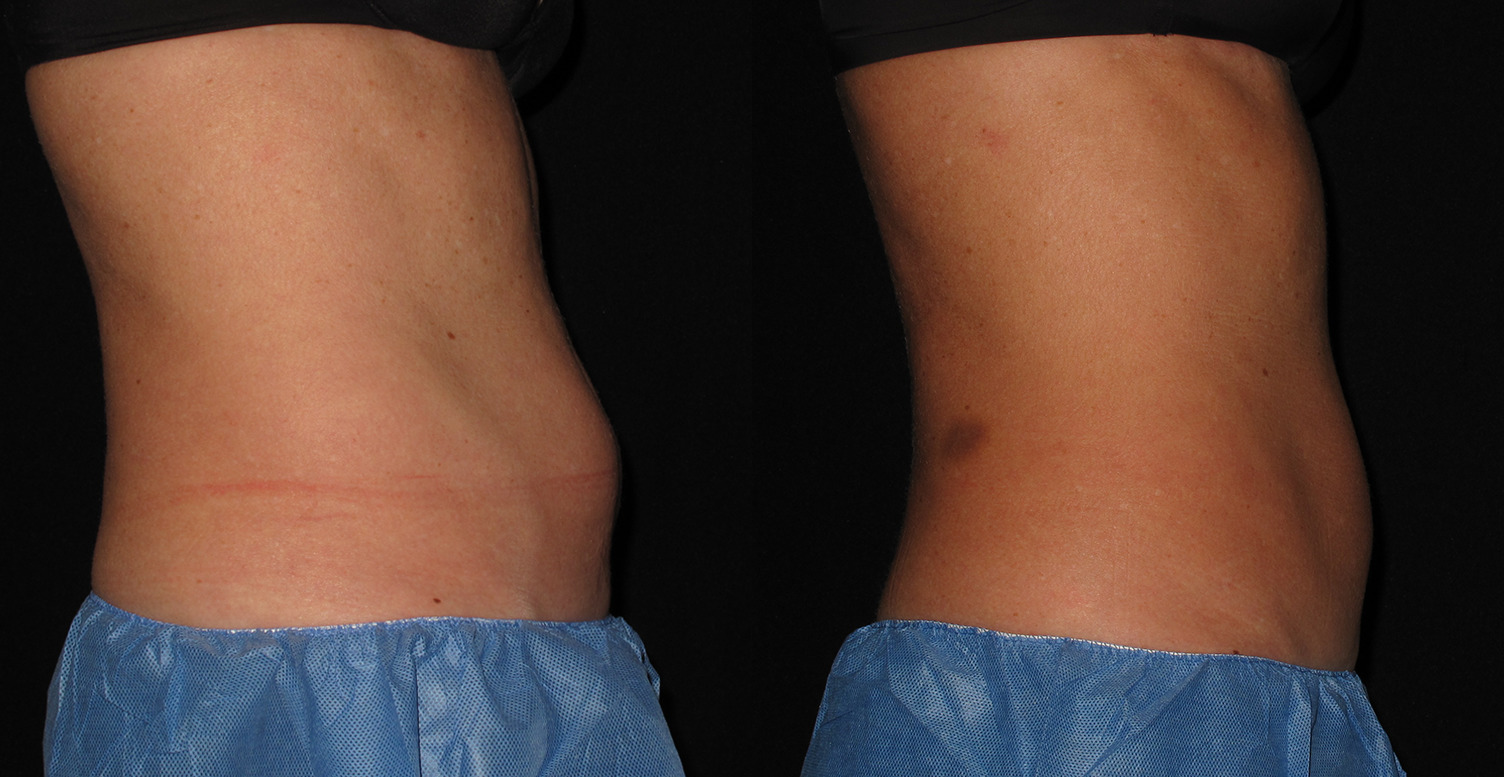 Coolsculpting Case #168 Marge Image