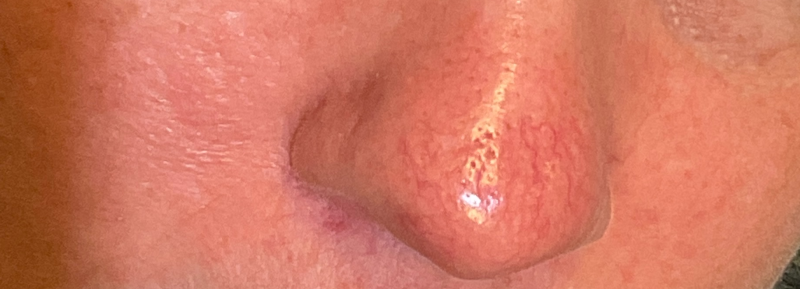 Facial Vein Treatment Case #238 After Image