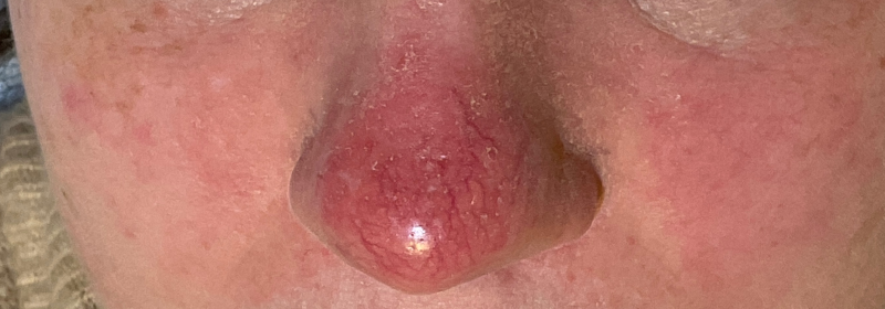 Facial Vein Treatment Case #238 Before Image