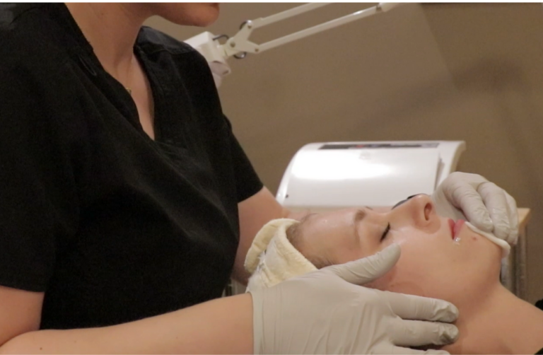 chemical peel in greater milwaukee Image
