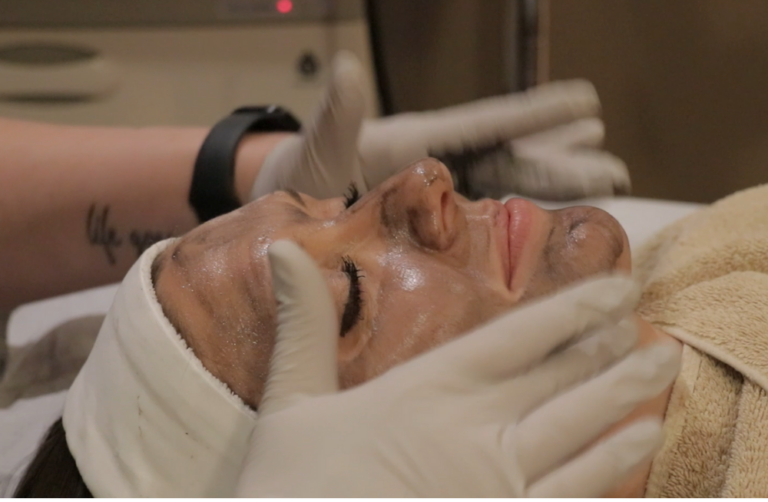 hollywood laser peel in greater milwaukee Image