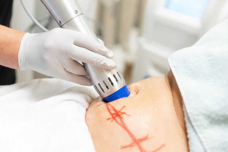 coolsculpting® elite in greater milwaukee Image
