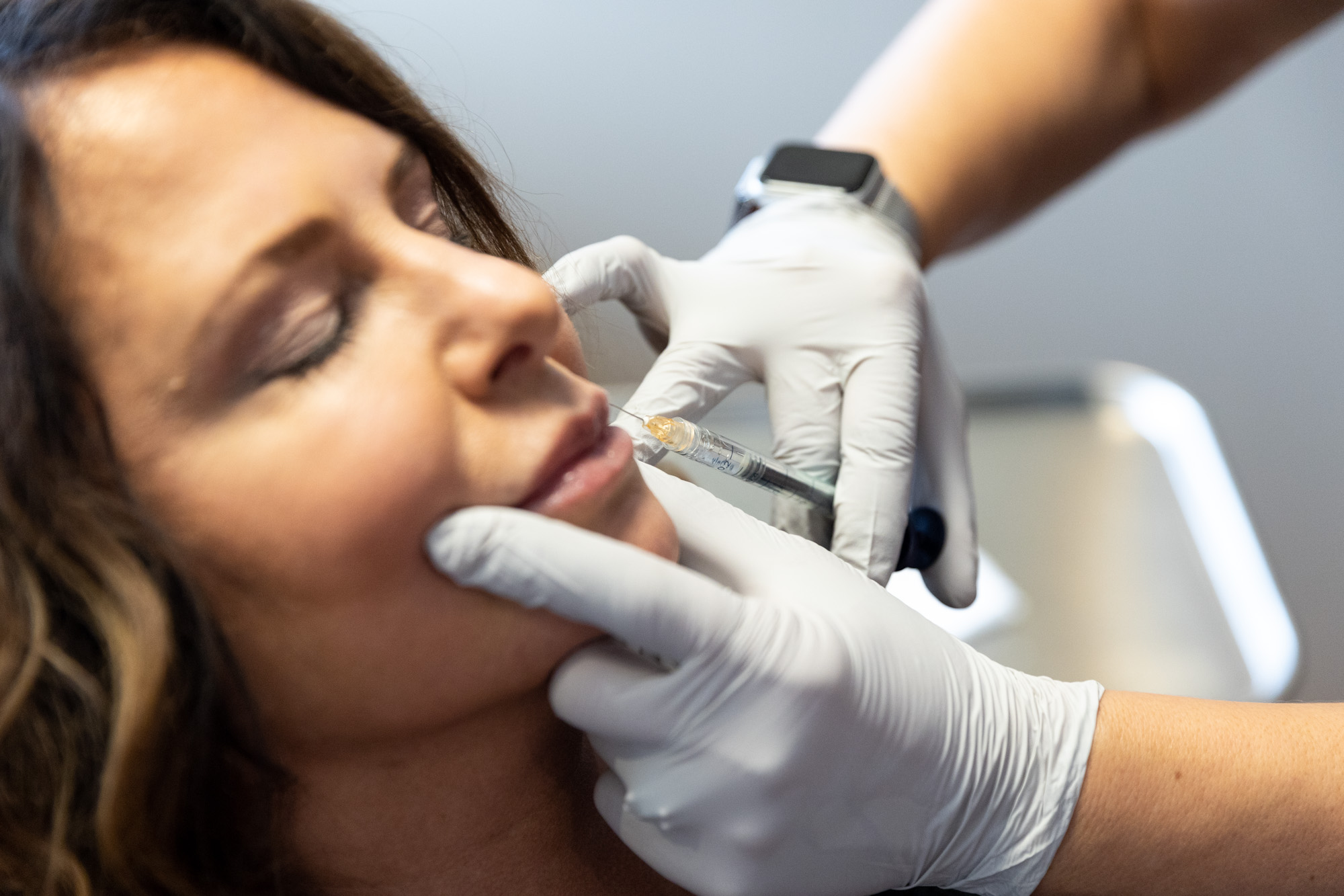 lip fillers near milwaukee Image