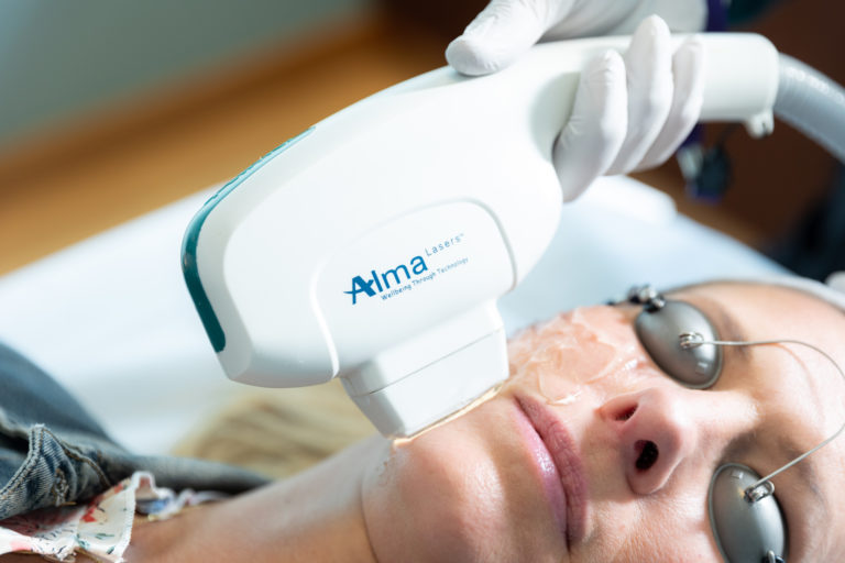 facial vein treatment in greater milwaukee Image