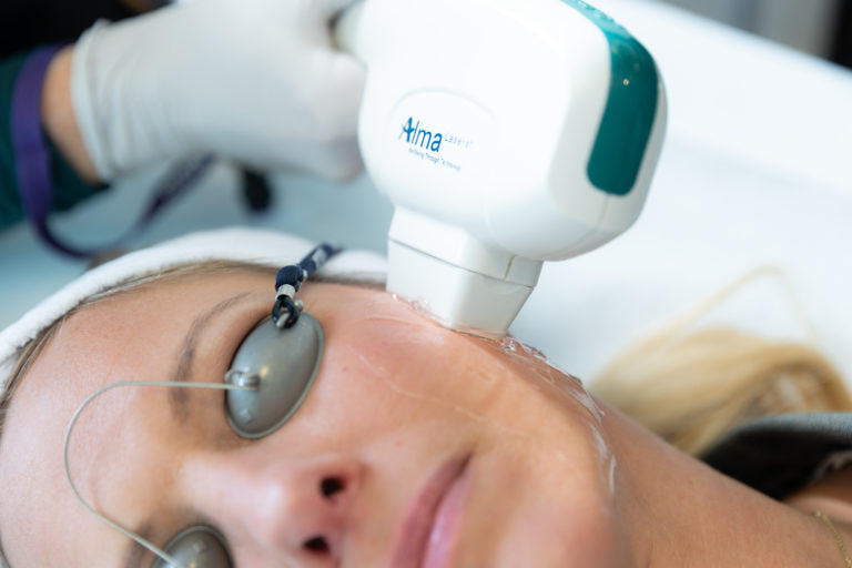 harmony aft photofacial in milwaukee Image