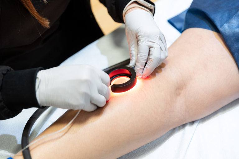 spider vein treatments in milwaukee Image