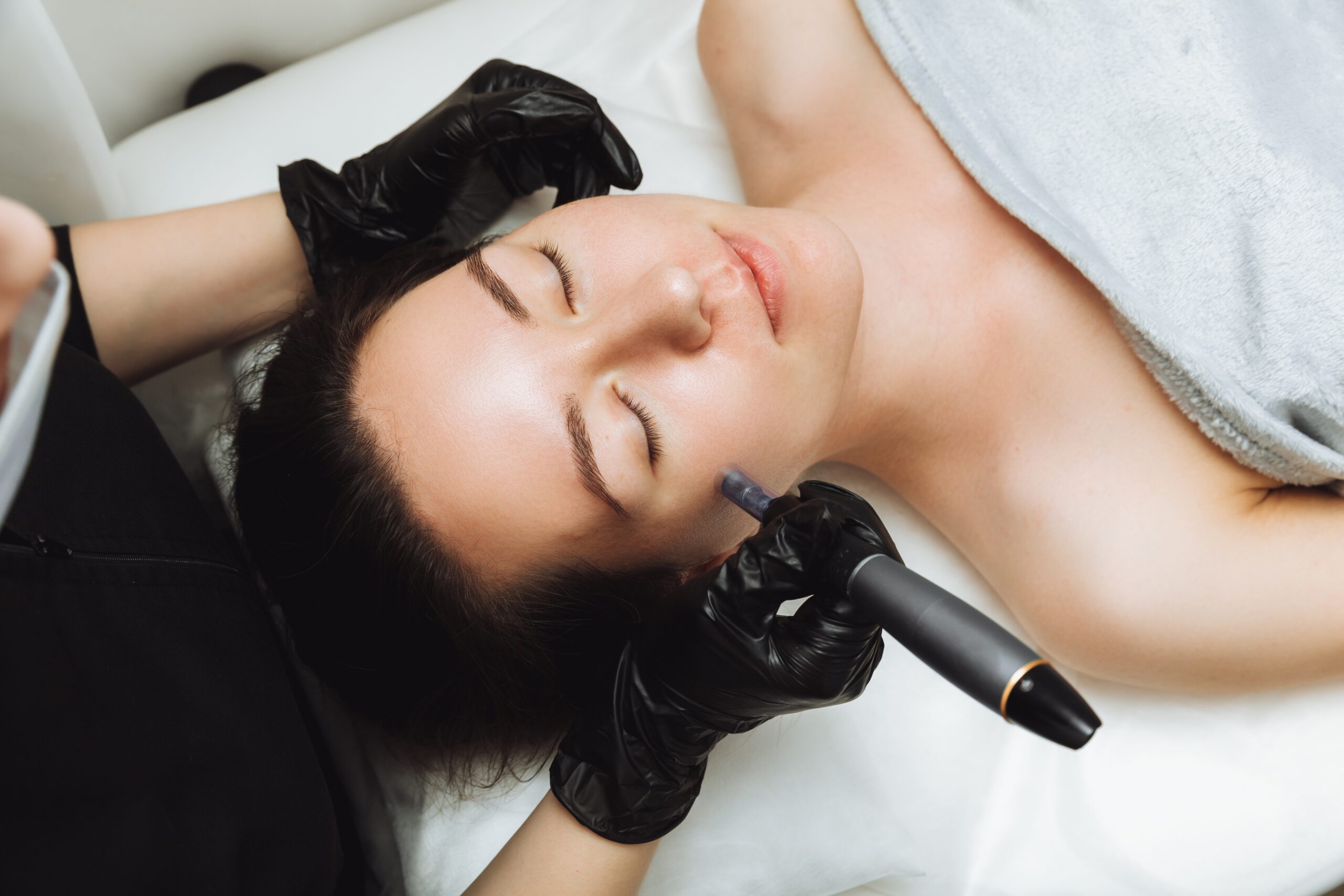 Microneedling in Brookfield WI Image