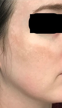 LaseMD Case #198 After Image