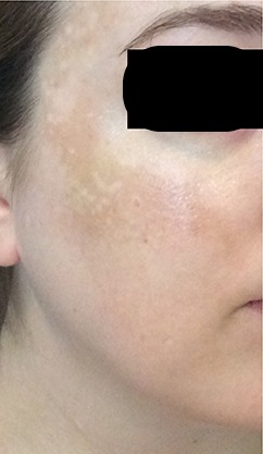LaseMD Case #198 Before Image