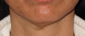 RF Microneedling Case #92 After Image