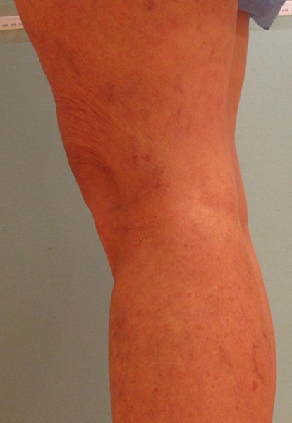 Spider Veins Case #182 After Image