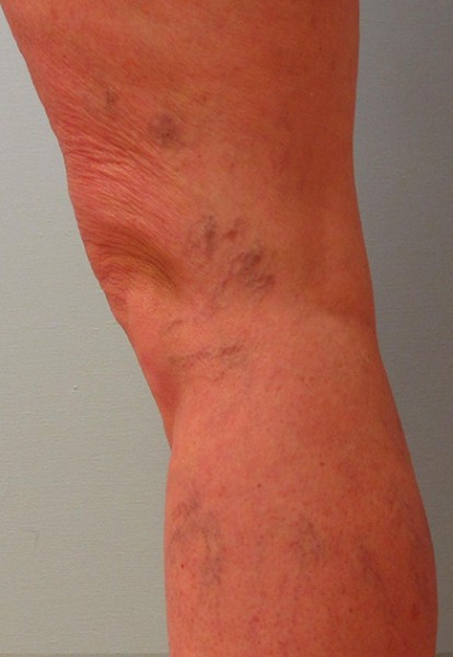 Spider Veins Case #182 Before Image