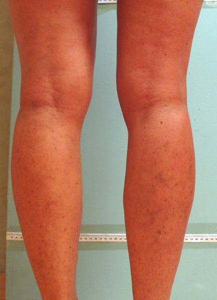 Spider Veins Case #196 After Image