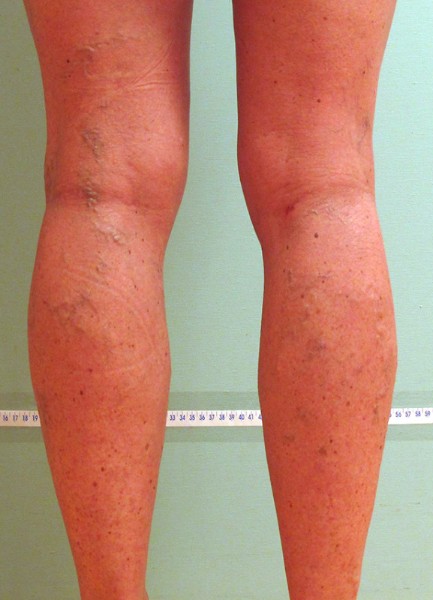 Spider Veins Case #196 Before Image