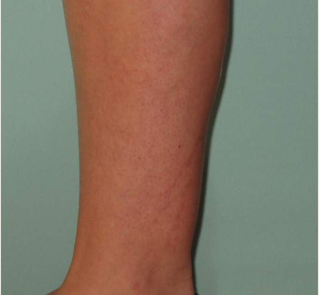 Spider Veins Case #250 After Image