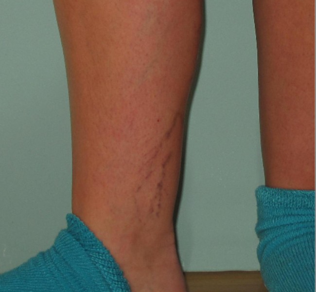 Spider Veins Case #250 Before Image