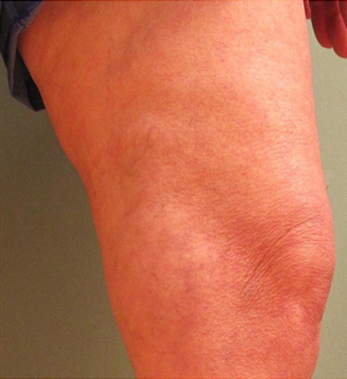 Spider Veins Case #251 After Image