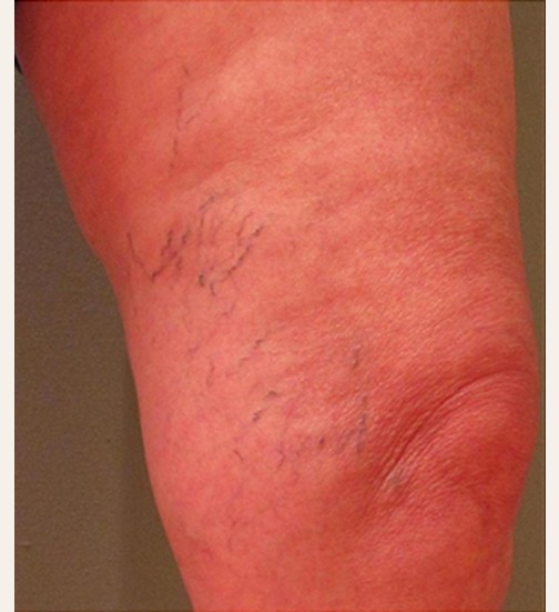 Spider Veins Case #251 Before Image
