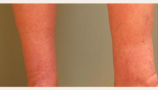 Spider Veins Case #252 After Image
