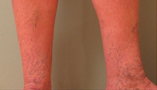 Spider Veins Case #252 Before Image