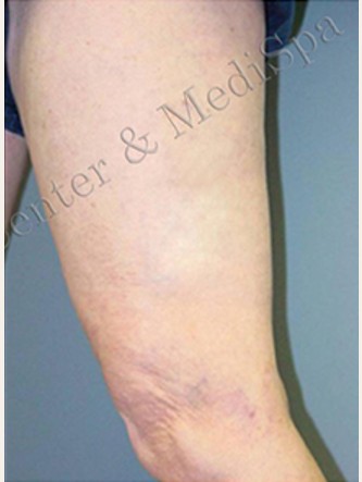 Spider Veins Case #253 After Image