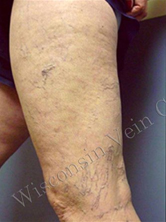 Spider Veins Case #253 Before Image