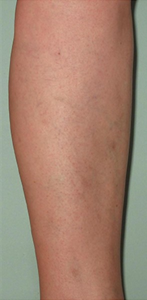 Spider Veins Case #254 After Image