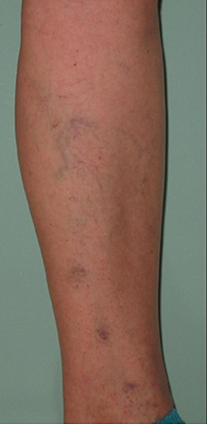 Spider Veins Case #254 Before Image